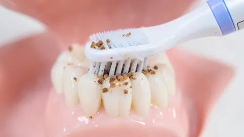 Czy szczoteczka elektryczna usuwa kamień